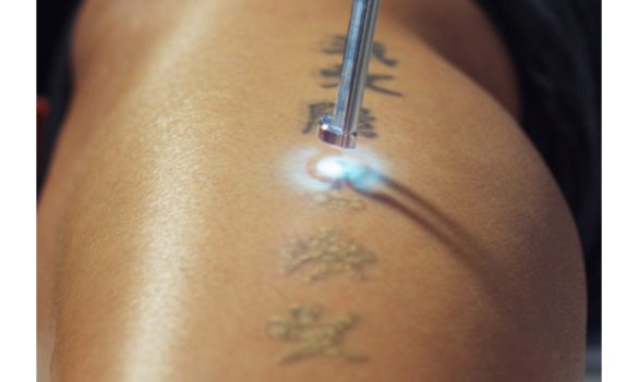Tattoo Removal